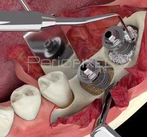 Peri-implantitis: Surgical regenerative treatment