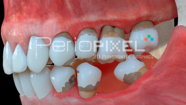 video 3d consecuencias ausencia dental